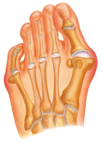 Tailor's Bunion